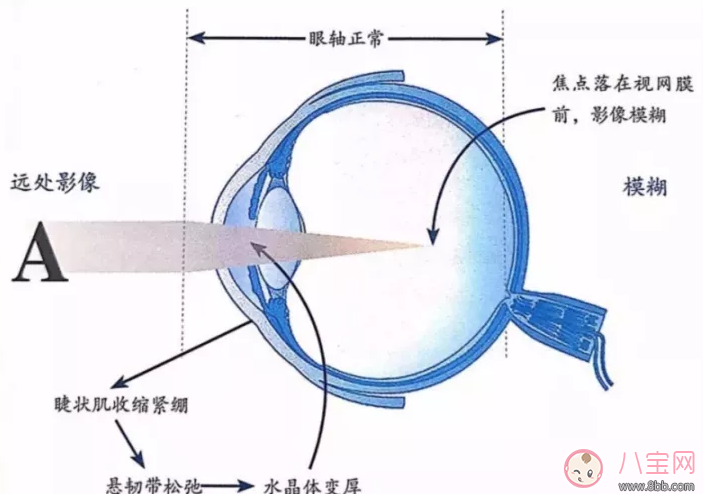 孩子生活中喜歡把眼睛瞇著是近視了嗎 孩子瞇眼看電視近視嗎