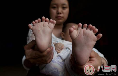 多指癥會遺傳幾代 多指癥由顯性基因控制還是隱性基因控制 多指癥會遺傳幾代 多指癥由顯性基因控制還是隱性基因控制