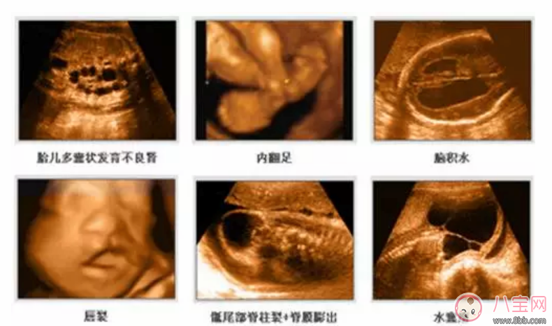 四維彩超多少錢 四維彩超檢查報(bào)告怎么看