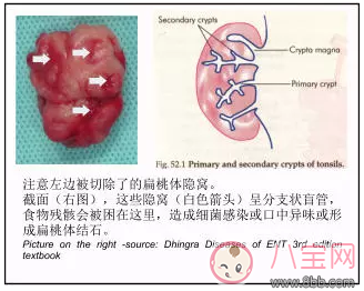 孩子為什么總是扁桃體發炎 孩子扁桃體發炎可以預防嗎
