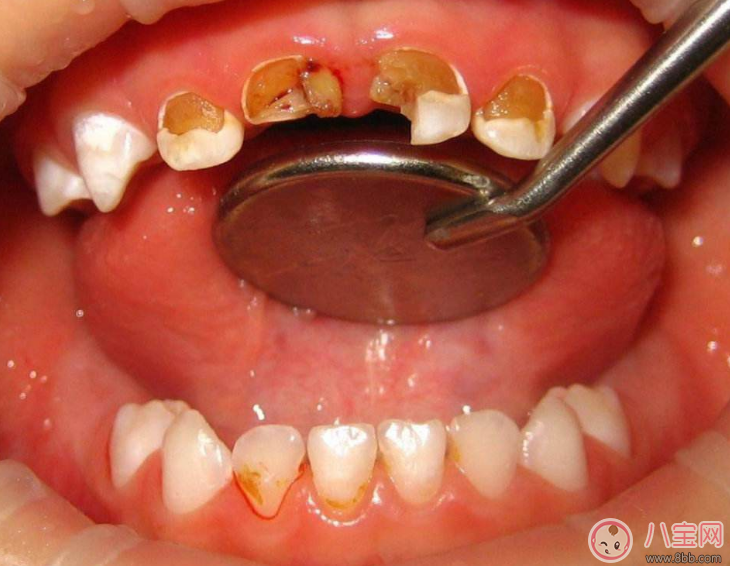 孩子齲齒怎么辦 怎么降低孩子得齲齒的概率 孩子齲齒怎么辦 怎么降低孩子得齲齒的概率