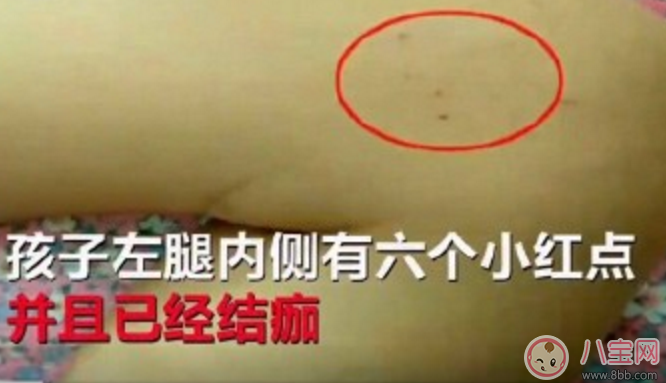 小孩皮膚被針扎了的針眼圖片 怎么判斷小孩皮膚是否被針扎了