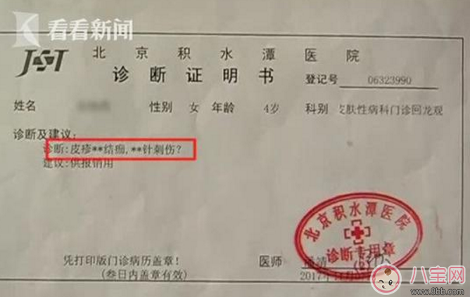 小孩皮膚被針扎了的針眼圖片 怎么判斷小孩皮膚是否被針扎了
