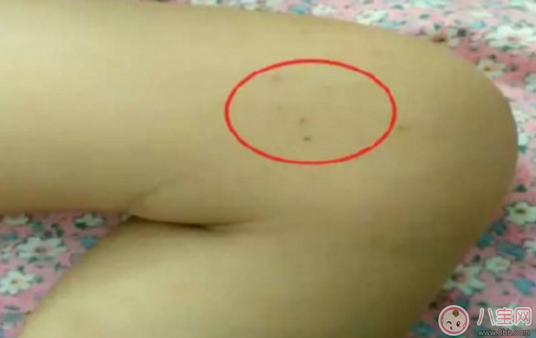 小孩皮膚被針扎了的針眼圖片 怎么判斷小孩皮膚是否被針扎了