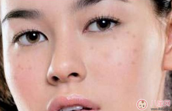 產后祛斑什么時間最合適 產后祛斑有什么好的方法