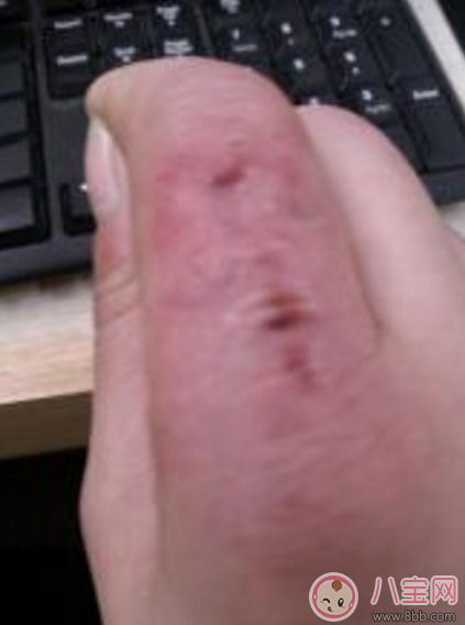 怎么預防寶寶冬天被凍傷 寶寶凍傷了怎么處理 怎么預防寶寶冬天被凍傷 寶寶凍傷了怎么處理