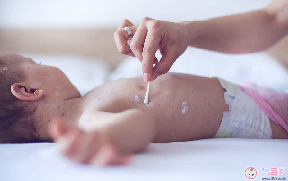 孩子得水痘的初期癥狀是什么 怎么知道孩子得水痘了 孩子得水痘的初期癥狀是什么 怎么知道孩子得水痘了