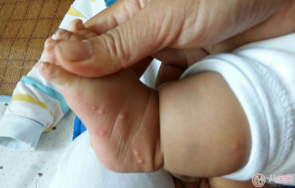 孩子得水痘的初期癥狀是什么 怎么知道孩子得水痘了 孩子得水痘的初期癥狀是什么 怎么知道孩子得水痘了