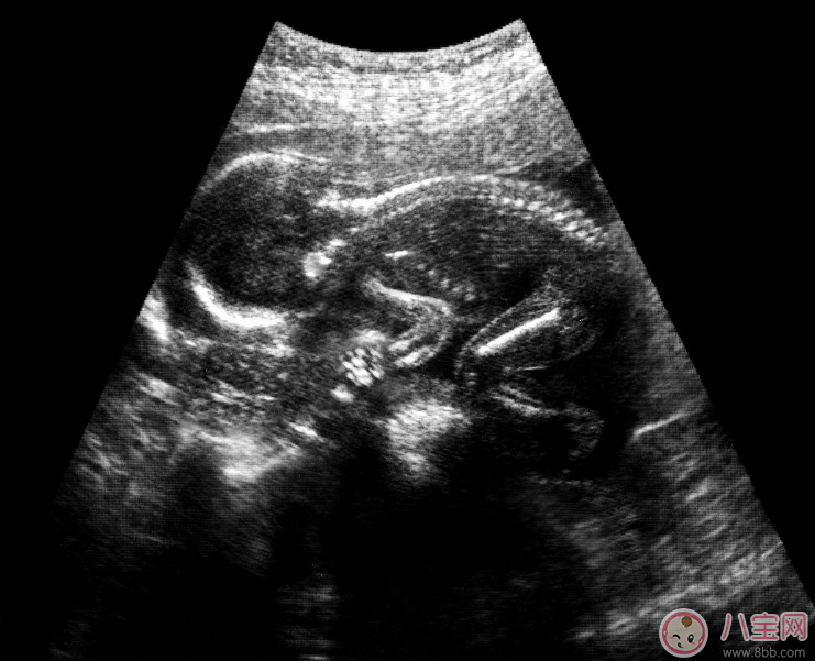 懷孕做了X光之后會怎么樣 做X光后多久可以懷孕