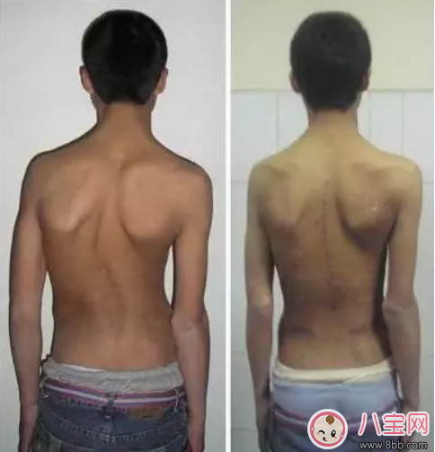 孩子總低頭玩王者榮耀會脊椎側彎嗎   如何檢查寶寶是否脊椎側彎