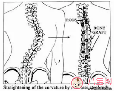 孩子總低頭玩王者榮耀會脊椎側彎嗎   如何檢查寶寶是否脊椎側彎