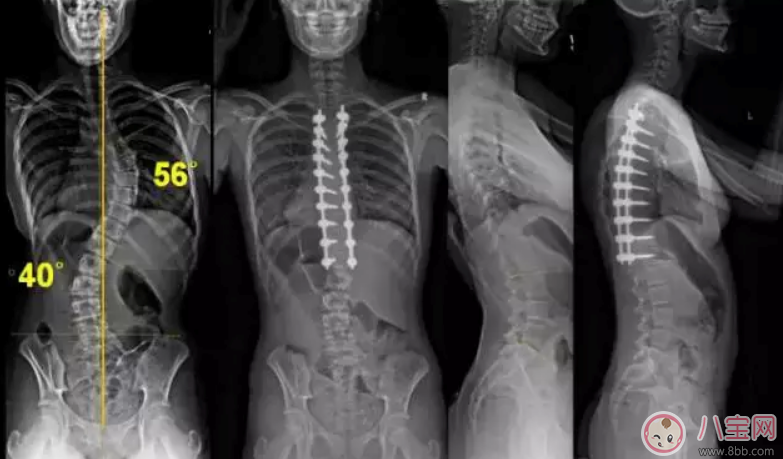 孩子高低肩膀駝背含胸怎么辦   如何預防孩子脊椎側彎