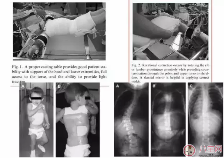 孩子高低肩膀駝背含胸怎么辦   如何預防孩子脊椎側彎