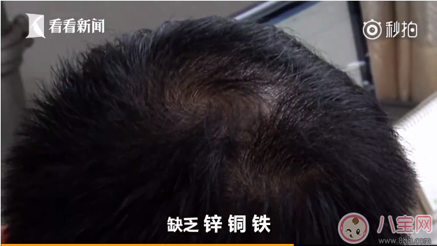 孩子得斑禿怎么辦 去醫(yī)院看斑禿掛什么科