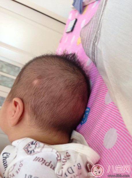 孩子得斑禿怎么辦 去醫(yī)院看斑禿掛什么科