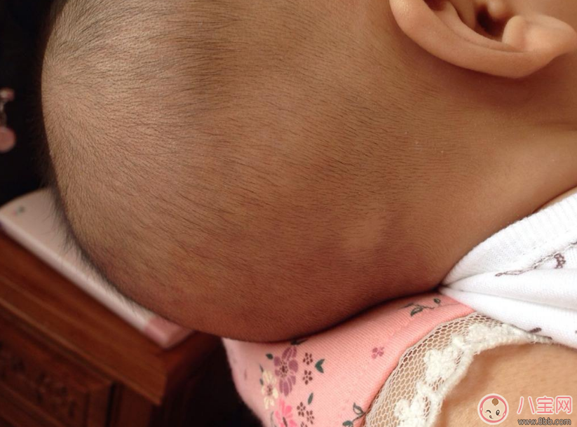 孩子得斑禿怎么辦 去醫(yī)院看斑禿掛什么科