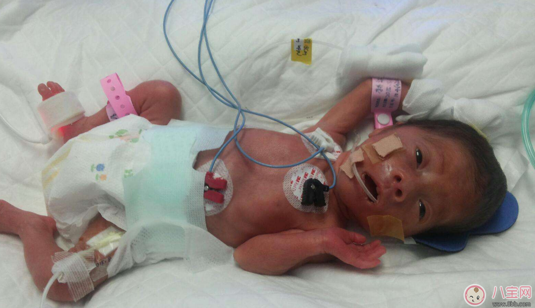 早產兒體質太虛弱怎么辦 怎么提高早產寶寶的免疫力