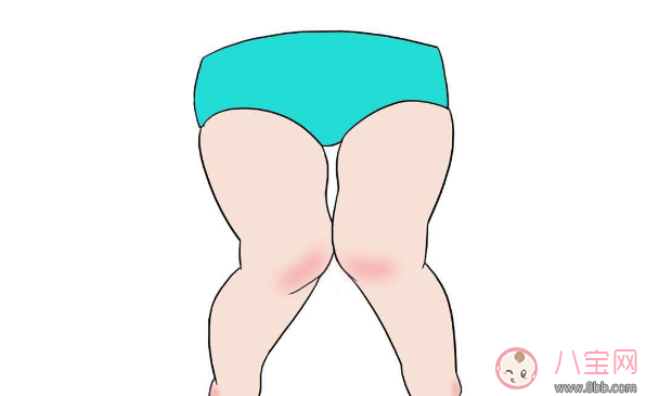 寶寶走路姿勢不對是有什么病 寶寶走路姿勢預(yù)示疾病真的嗎 寶寶走路姿勢不對是有什么病 寶寶走路姿勢預(yù)示疾病真的嗎