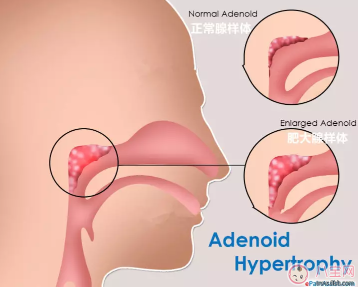 孩子喜歡打鼾是不是因為扁桃體發炎 孩子扁桃體發炎怎么辦 孩子喜歡打鼾是不是因為扁桃體發炎 孩子扁桃體發炎怎么辦