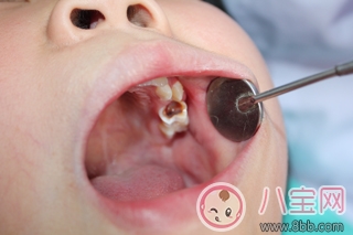 孩子蛀牙太疼怎么辦 孩子蛀牙的原因是什么