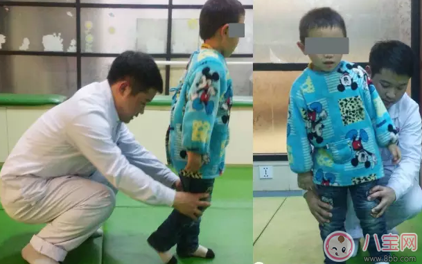 腳尖走路一定是腦癱嗎 腦癱寶寶腳尖著地圖片