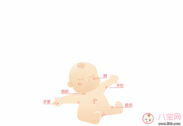 異位性皮膚炎和濕疹有什么區別  異位性皮膚炎常常會復發怎么辦