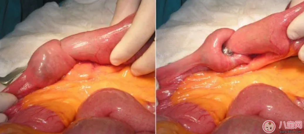 幼兒腸套疊怎么引起的  小兒腸套疊嚴重嗎