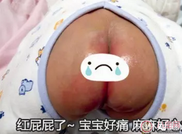 寶寶肛門特別紅是上火了嗎 寶寶屁股顏色深是什么原因