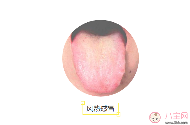 寶寶風寒感冒和風熱感冒舌頭對比圖 感冒舌頭上黃舌苔是風熱感冒嗎