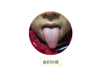 寶寶積食感冒舌頭圖片 怎么看寶寶是不是積食感冒有哪些癥狀