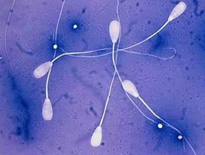 男性精子成活率低是什么原因 精子成活率低怎么治療