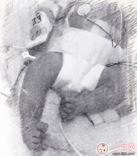 侯佩岑小兒子ABO溶血癥是蠶豆癥嗎  如何進行ABO溶血癥檢查