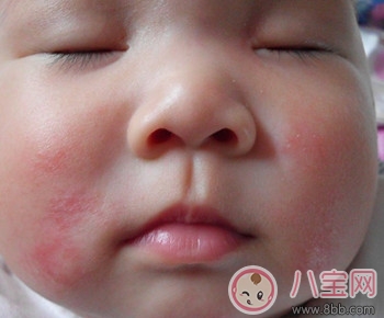 小兒濕疹的癥狀及治療方法 引發(fā)濕疹的原因有哪些 小兒濕疹的癥狀及治療方法 引發(fā)濕疹的原因有哪些