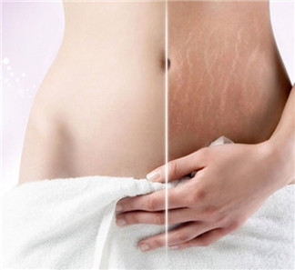 橄欖油能預(yù)防妊娠紋  真的有那么神奇嗎