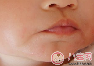 寶寶吃雞蛋過敏的癥狀  寶寶吃雞蛋過敏的圖片