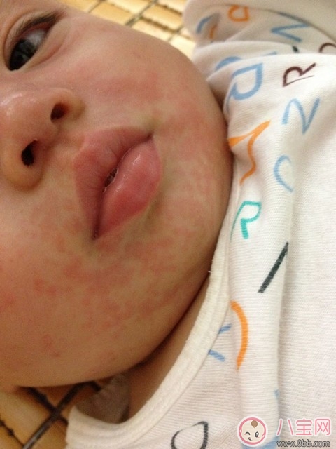 寶寶吃雞蛋過敏的癥狀  寶寶吃雞蛋過敏的圖片