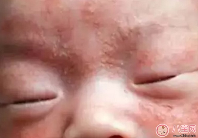 新生兒痤瘡預防 新生兒痤瘡特點是什么樣子 新生兒痤瘡預防 新生兒痤瘡特點是什么樣子