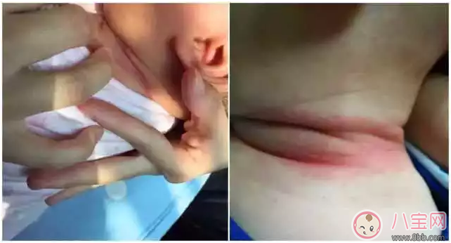 孩子淹脖子了怎么做好得快 孩子淹脖子抹什么藥好