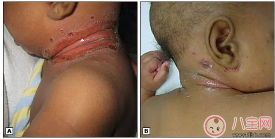 孩子淹脖子了怎么做好得快 孩子淹脖子抹什么藥好