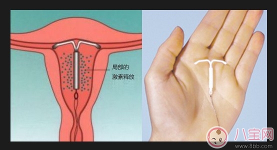 上環后什么時候可進行性生活 女性上環的最佳時期