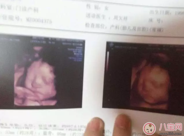 怎么通過四維彩超分辨男女 四維彩超怎么看比較好