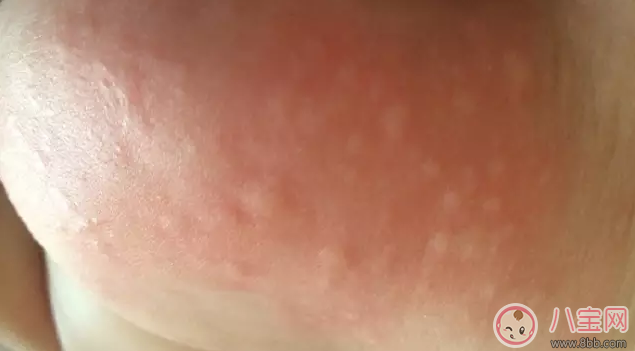 孩子過敏起疙瘩掛什么科 孩子過敏看什么醫(yī)生好