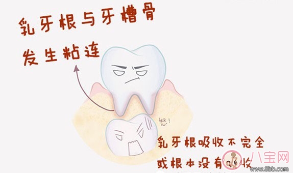 孩子乳牙沒有搖動卻長恒牙怎么回事 寶寶乳牙不搖就長恒牙怎么辦