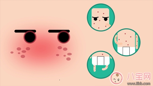 孕婦感染風疹是什么原因 孕婦感染風疹應該怎么辦 孕婦感染風疹是什么原因 孕婦感染風疹應該怎么辦