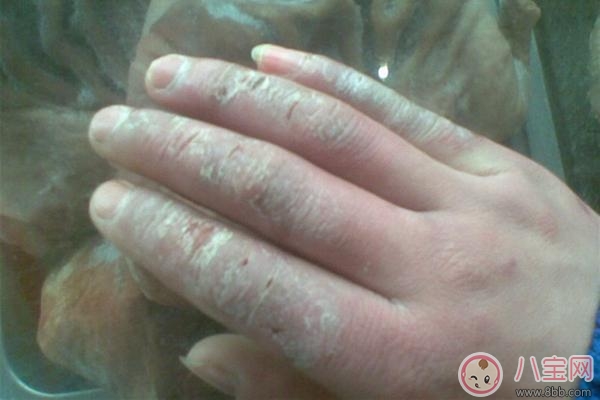 孩子凍瘡早期的治理方法是什么 孩子凍瘡的預防措施有哪些 孩子凍瘡早期的治理方法是什么 孩子凍瘡的預防措施有哪些