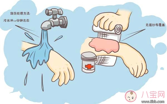 寶寶燙傷用什么藥好 寶寶燙傷應該怎么辦 寶寶燙傷用什么藥好 寶寶燙傷應該怎么辦