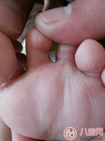 寶寶有腳氣怎么辦  你知道寶寶有腳氣的癥狀嗎