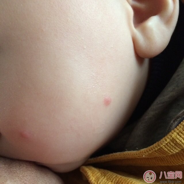 寶寶臉上起紅疙瘩怎么回事  寶寶臉上起紅疙瘩怎么辦