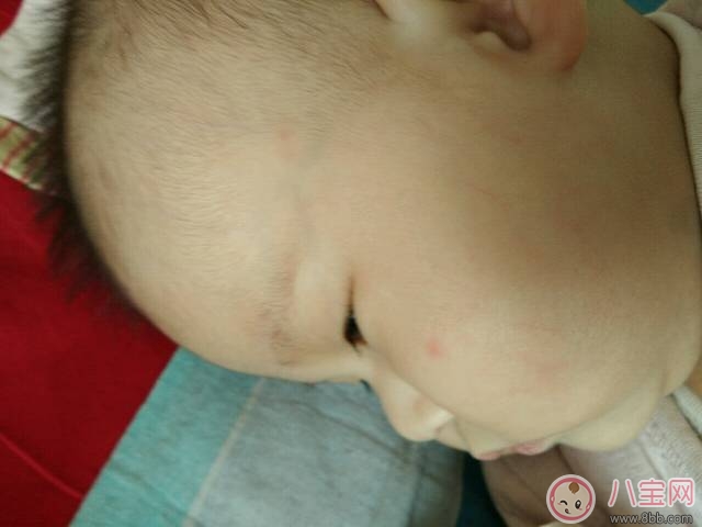 寶寶臉上起紅疙瘩怎么回事  寶寶臉上起紅疙瘩怎么辦