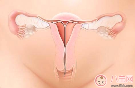 節育環多久換一次好 節育環的副作用有哪些 節育環多久換一次好 節育環的副作用有哪些